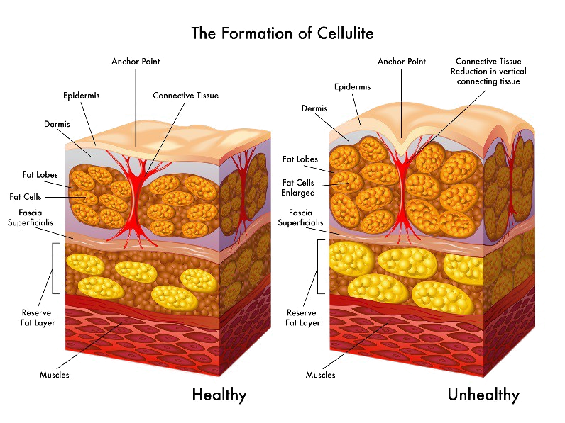 The formation of cellulite breakdown